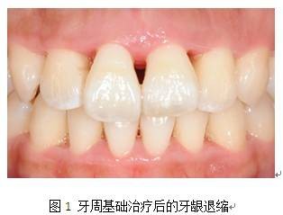 牙龈退缩