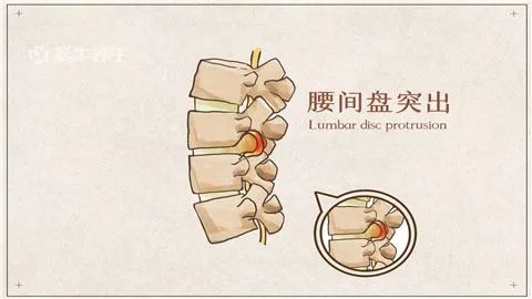 腰椎间盘突出怎样治