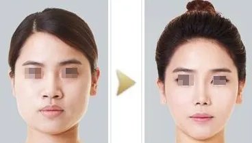 瘦脸针后注意事项