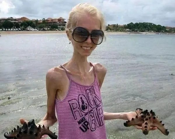 张若昀瘦到青筋凸起,过于消瘦对身体有何危害?