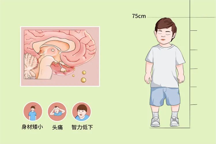 矮小症图片