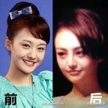 你们觉得郑爽整容前漂亮还是整容后漂亮?