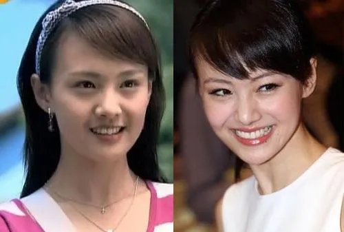 你们觉得郑爽整容前漂亮还是整容后漂亮?