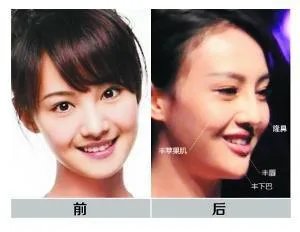 你们觉得郑爽整容前漂亮还是整容后漂亮?