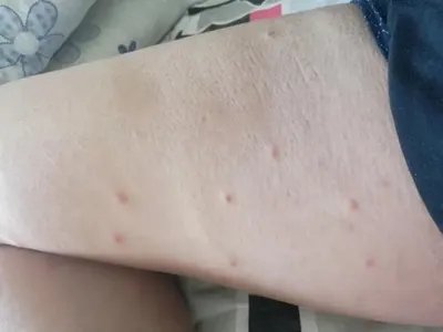 单纯性痒疹大腿症状图片
