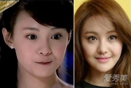 你们觉得郑爽整容前漂亮还是整容后漂亮?