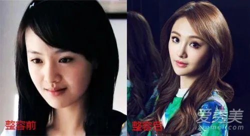 你们觉得郑爽整容前漂亮还是整容后漂亮?
