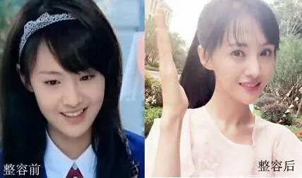 你们觉得郑爽整容前漂亮还是整容后漂亮?