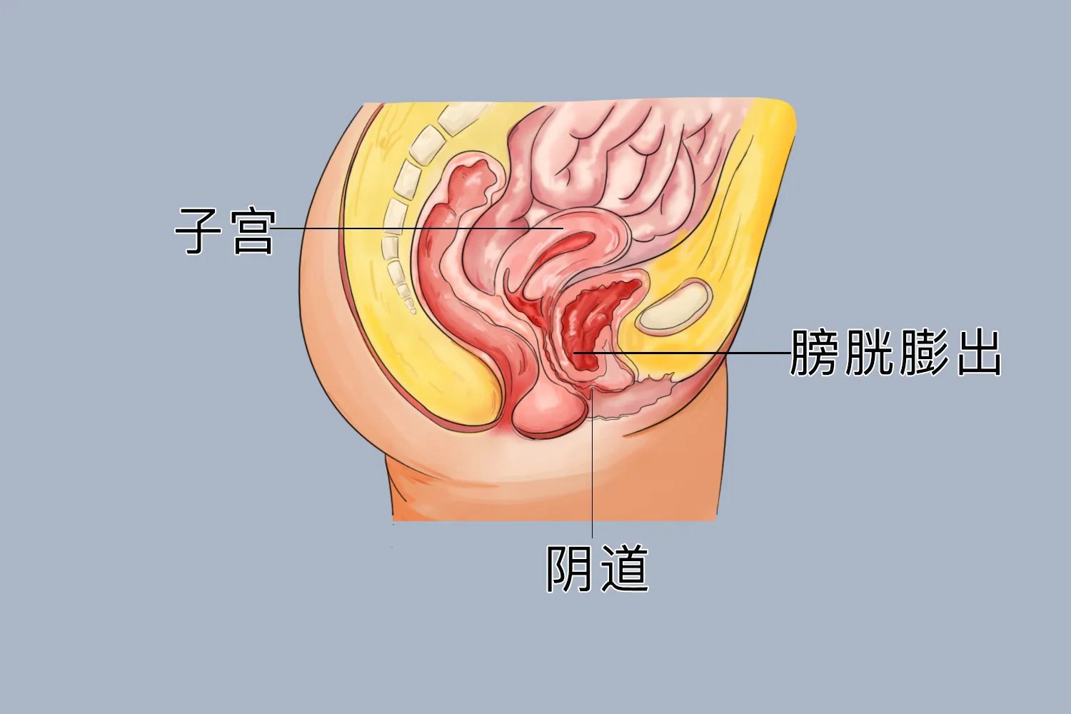 顺产后阴壁膨出症状图
