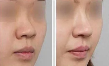 蒜头鼻整形前后对比图