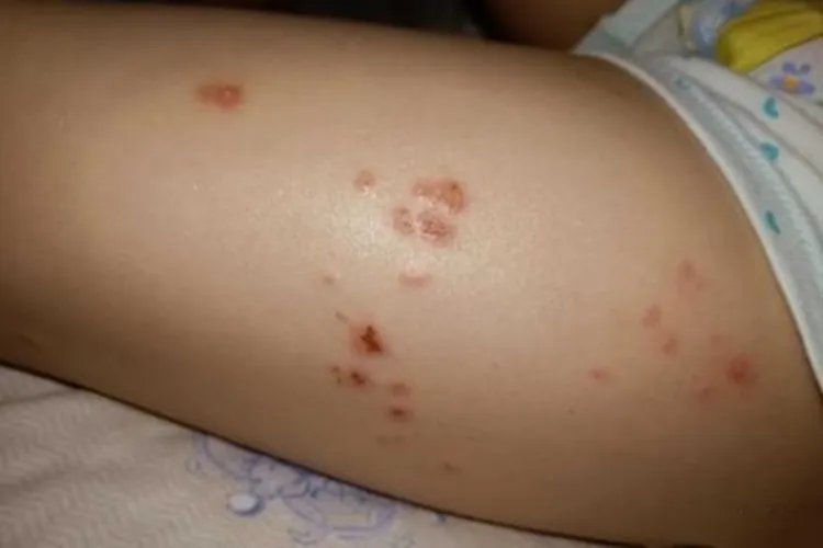 小儿痒疹症状图片