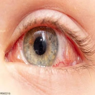 眼睛玻璃体混浊的治疗方法有哪些