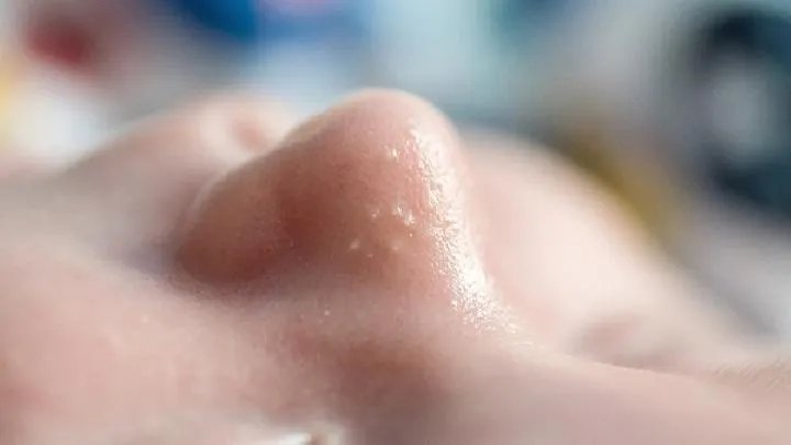 您了解隆鼻前后对比吗