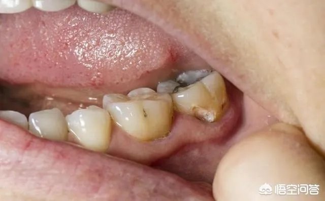 最后一颗大牙坏了一个洞，现在牙龈好痛，该怎么办呢？
