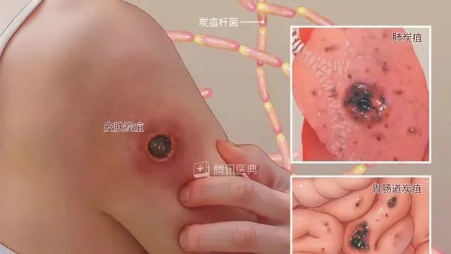 山东出现炭疽死亡病例!至少三地有人确诊,它是如何进行传播的?