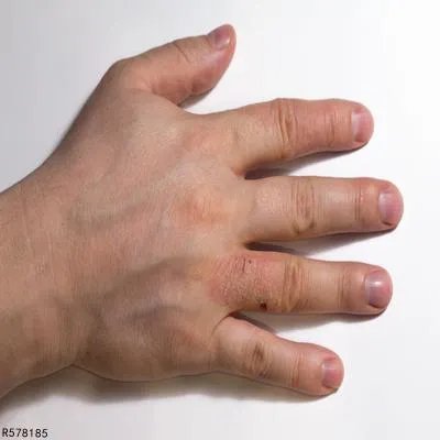 手上生疥疮怎么办