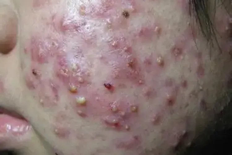 怎么判断自己痘痘的类型图片