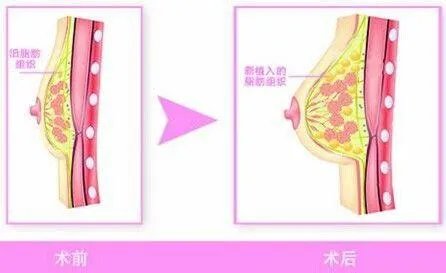 做自体脂肪隆胸的怎么样?
